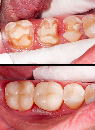 River Oaks Advanced Dentistry | Family Dentistry, Veneers and ZOOM  Whitening