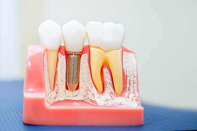River Oaks Advanced Dentistry | Oral Cancer Screening, Dental Fillings and Veneers