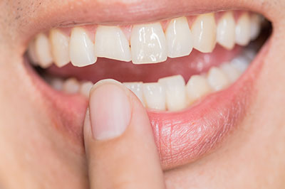 River Oaks Advanced Dentistry | Root Canals, Extractions and Crowns