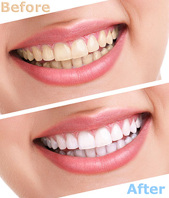 River Oaks Advanced Dentistry | Pediatric Dentistry, Veneers and Botox reg 